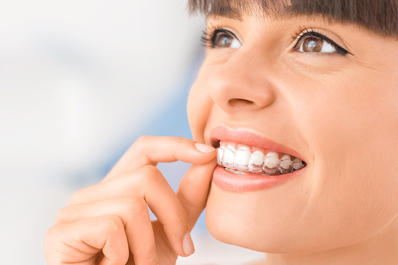 CandidPro Clear Aligners in Columbus